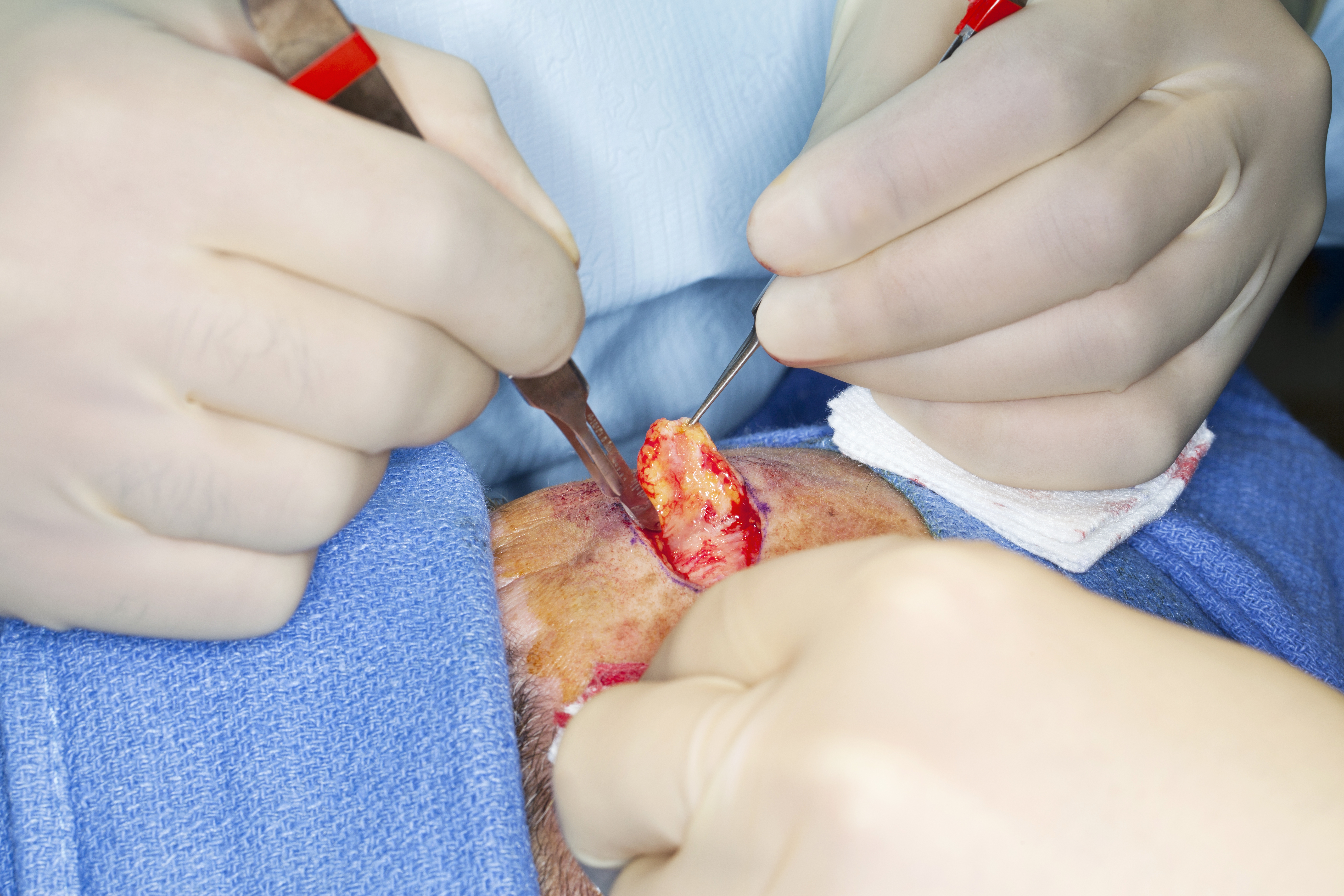 Find Skin Cancer Early Find Skin Cancer Early