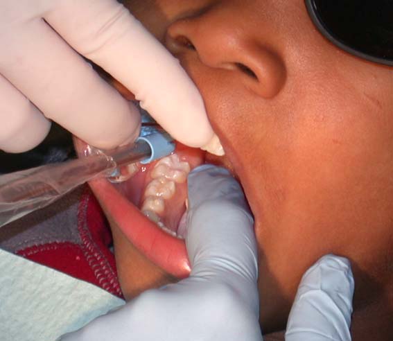 dental sealants 